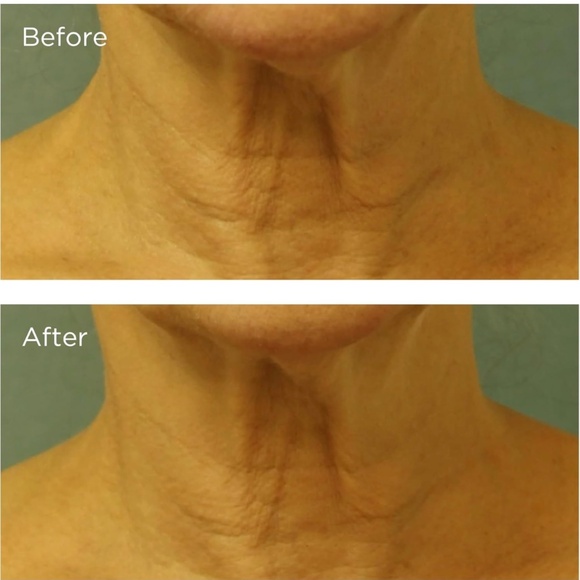 Perricone MD Cold Plasma Plus+ Neck & Chest Broad Spectrum Moisturizer - Picture 4 of 7